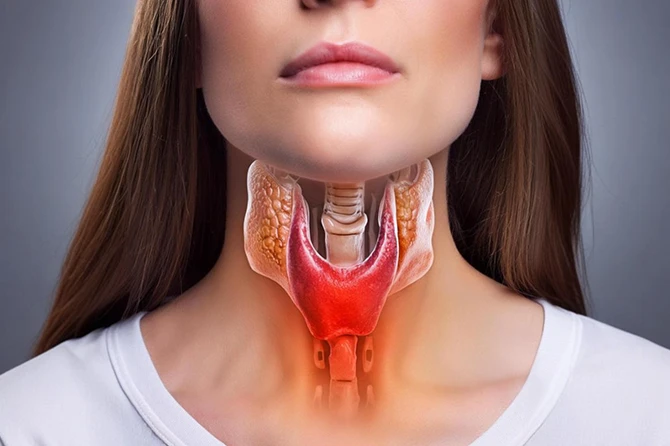 Tireoide inflamada na Síndrome de Hashimoto